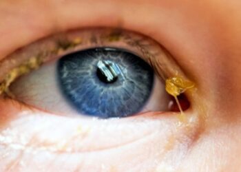 De una simple lagaña a una infección: cuándo ir al especialista