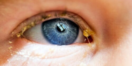 De una simple lagaña a una infección: cuándo ir al especialista