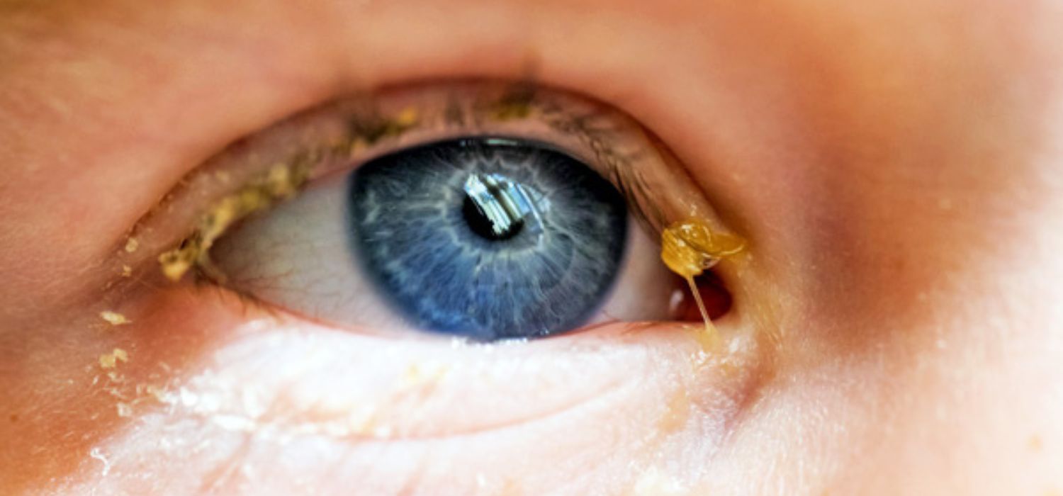 lagaña a una infección