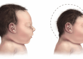 Casos de microcefalia aumentan en Yucatán: Qué es y cómo prevenirla