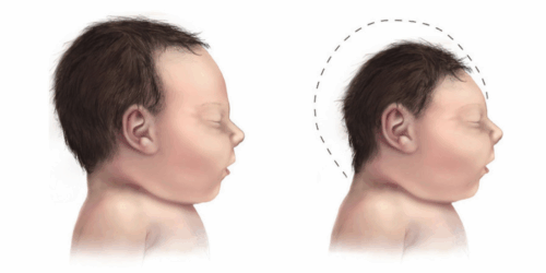 Casos de microcefalia aumentan en Yucatán: Qué es y cómo prevenirla